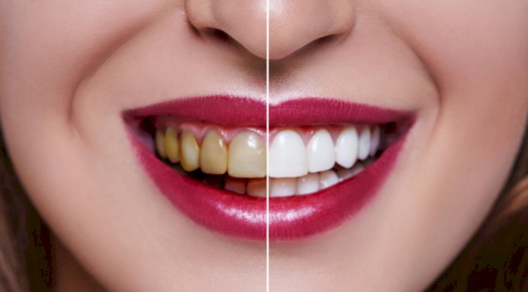 Sararan Dişleri 3 Tona Kadar Açarak Işıldayın! Bu Doğal Yöntem Sararan Dişleri Bembeyaz Ortaya Çıkarıyor, üstelik antiseptik özelliği de var 